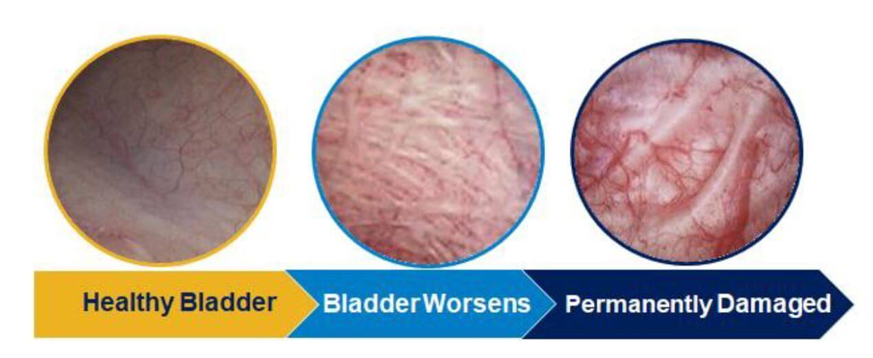 Bladder