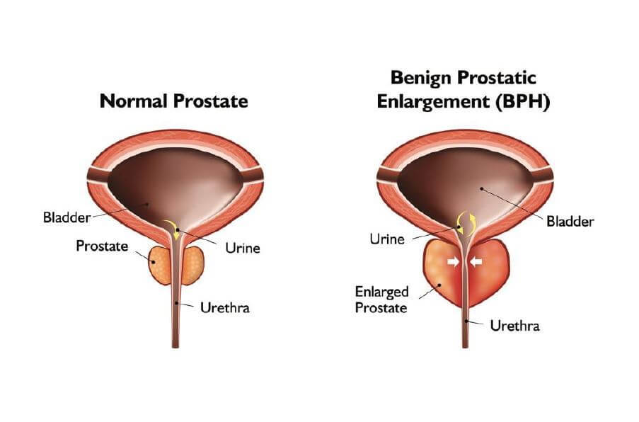 Difference of Normal Prostate and Benign Prostate Enlargement